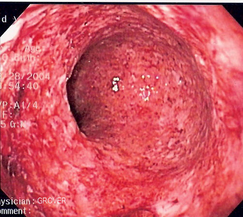 Sigmoid colon endoscopy