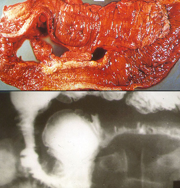 Crohn's bowel image and xray